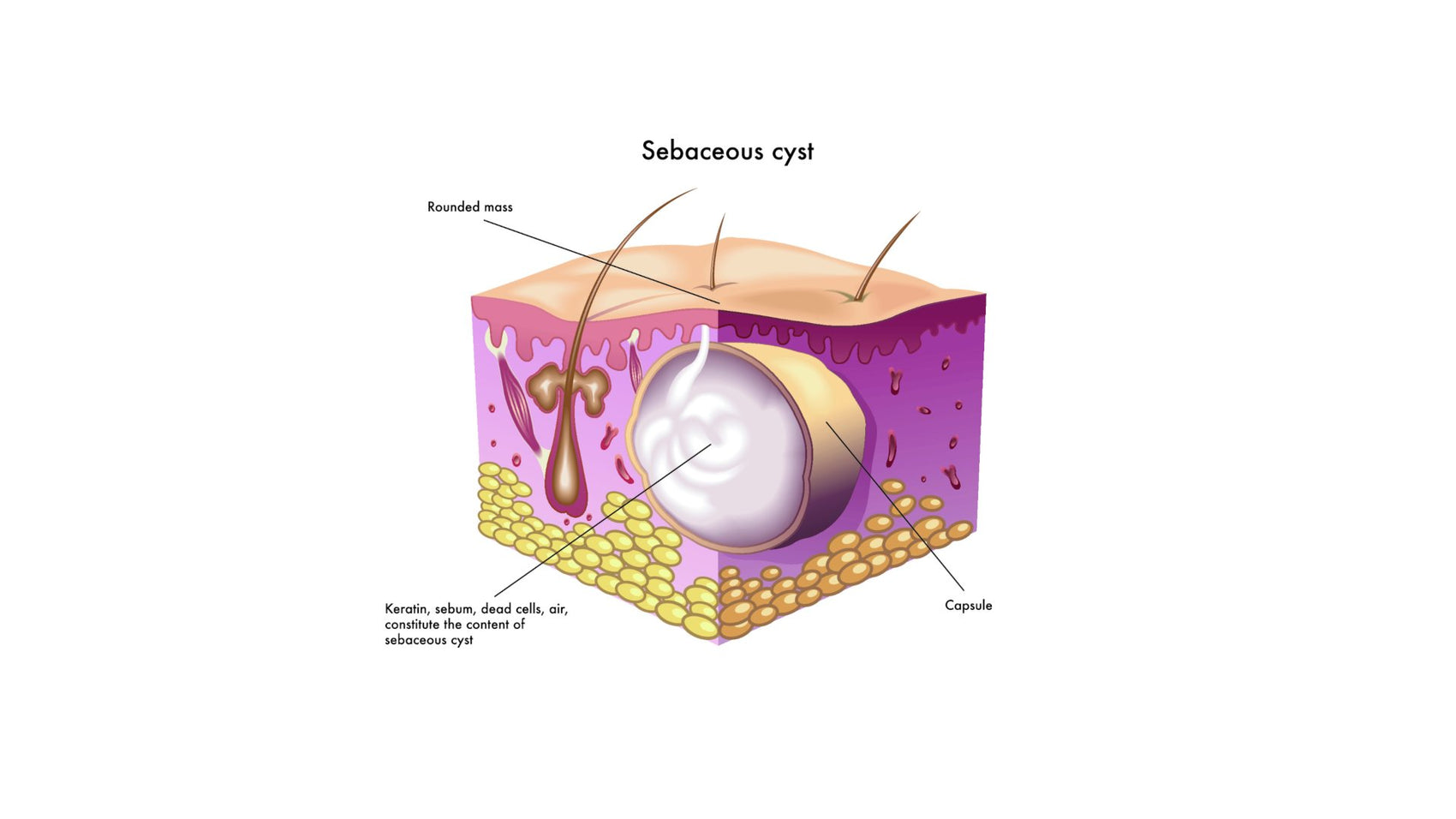 how to dissolve cysts naturally